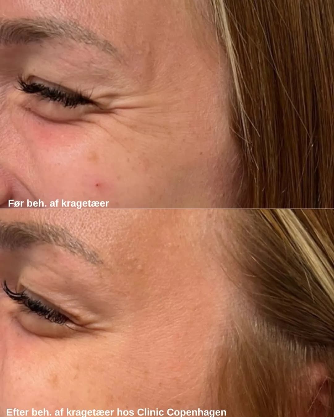 Botox kragetæer før og efter — glattere hud omkring øjnene