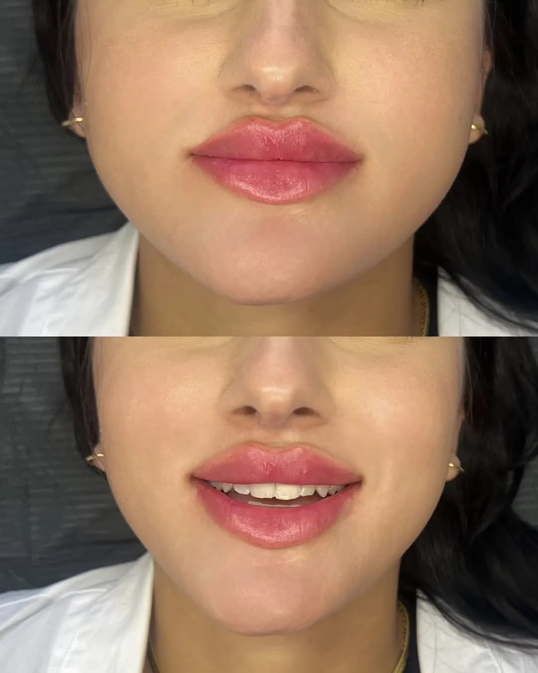 CC Lips — naturligt volumen og harmonisk form
