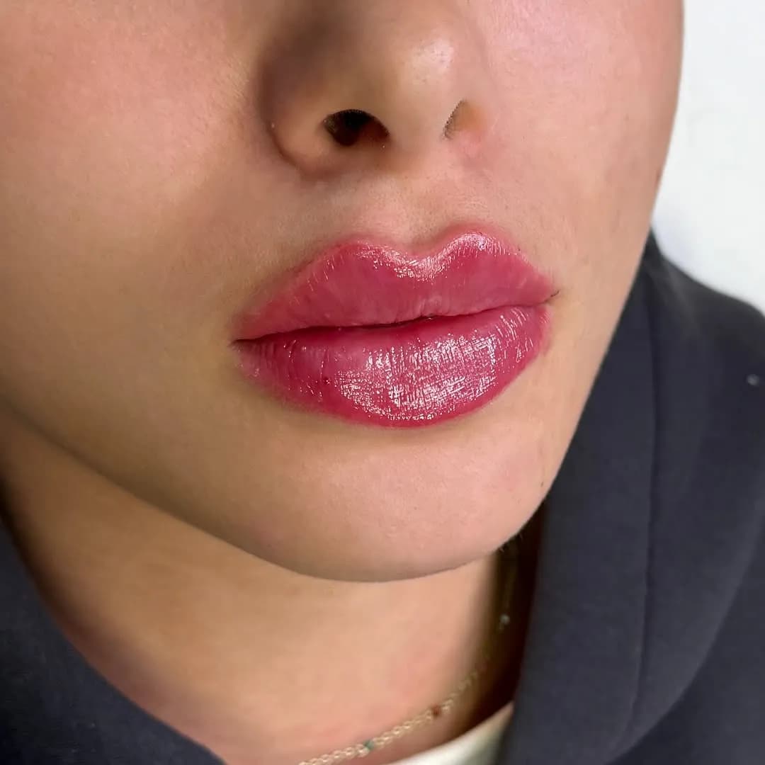 Filler facial balancing — harmonisk ansigtsbalance